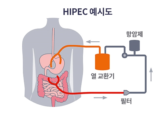 난소암 하이펙 수술 치료 과정 설명 이미지